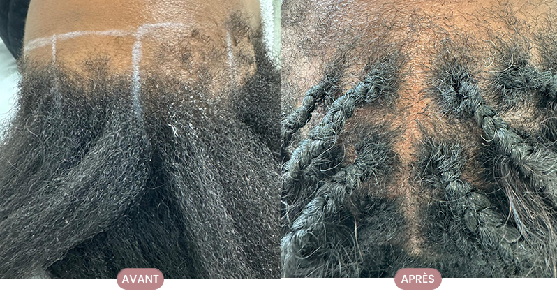 Avant/après amélioration de densité — consultation en trichologie