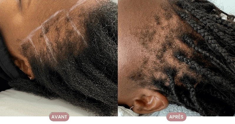 Avant/après amélioration de densité — consultation en trichologie