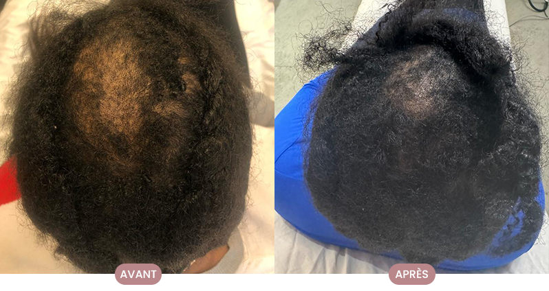 Avant et après la routine capillaire Crüe : cheveux revitalisés et sains