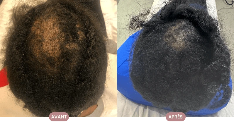 Avant et après la routine capillaire Crüe : cheveux revitalisés et sains