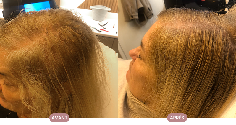 Avant-après d'une cliente Crüe montrant des cheveux plus longs et sains