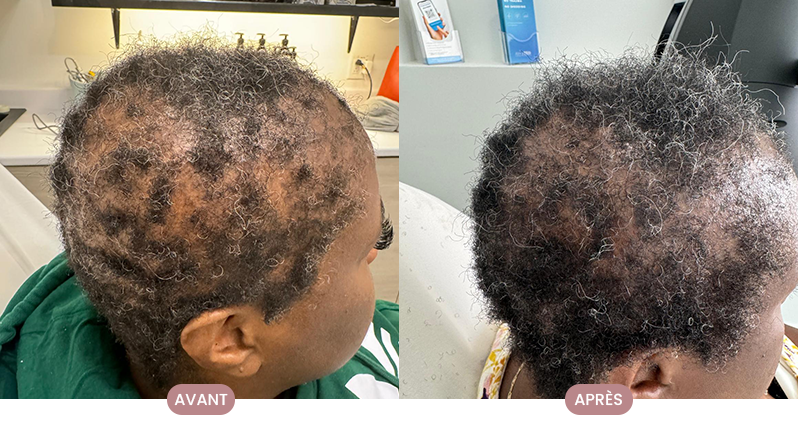 Cheveux plus forts et stimulés après le programme de soins Crüe