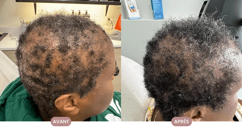 Cheveux plus forts et stimulés après le programme de soins Crüe